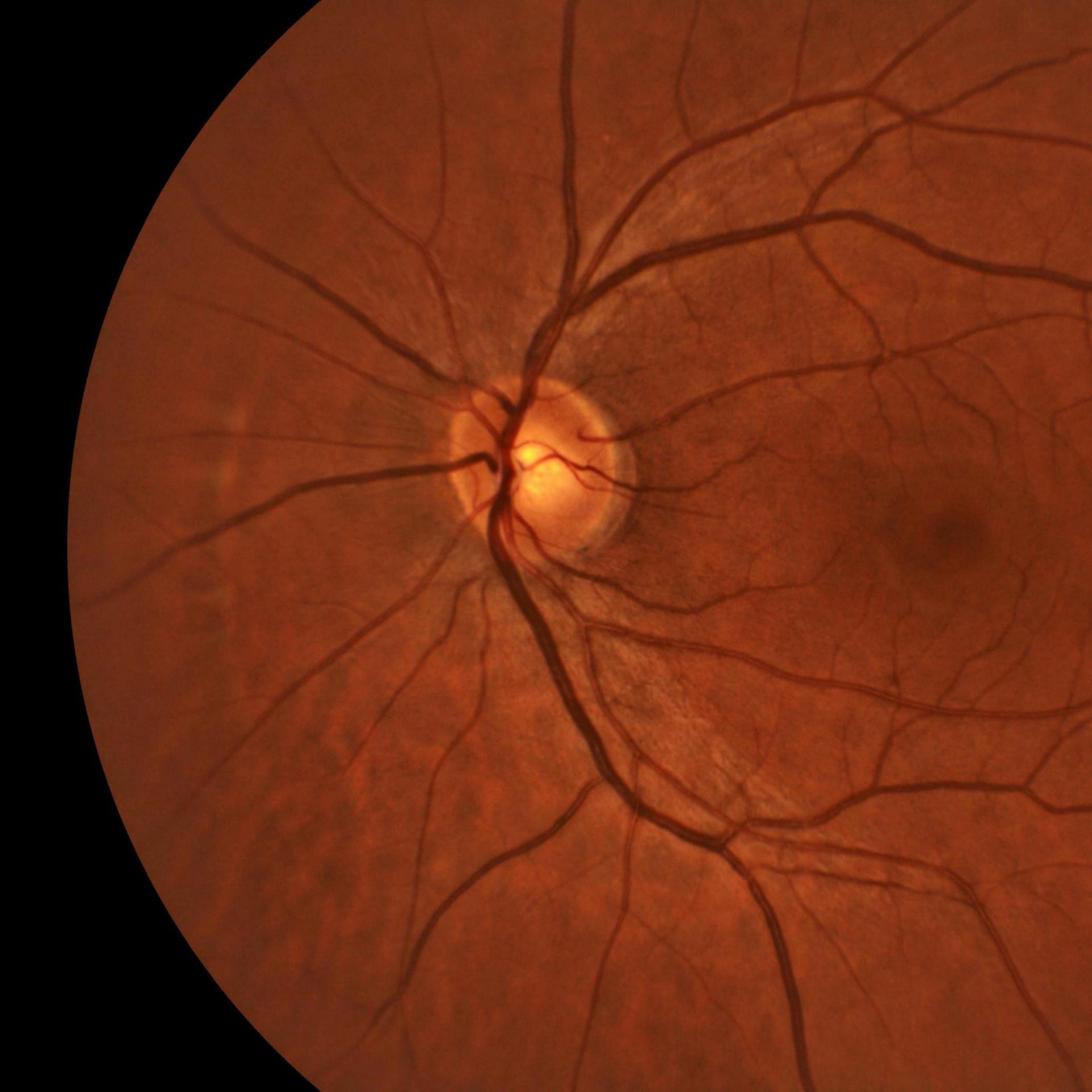 Analyse du segment postérieur.