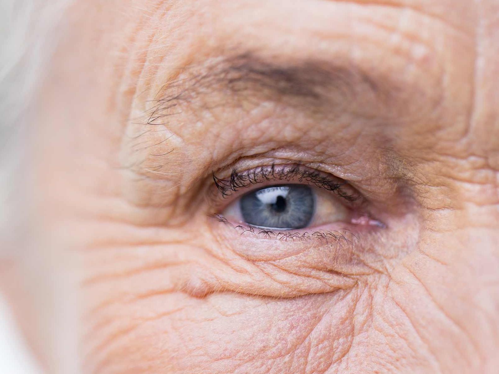 De afbeelding toont een close-up van een ongezond oog, wat de potentiële oculaire adnexa-gevaren illustreert. 