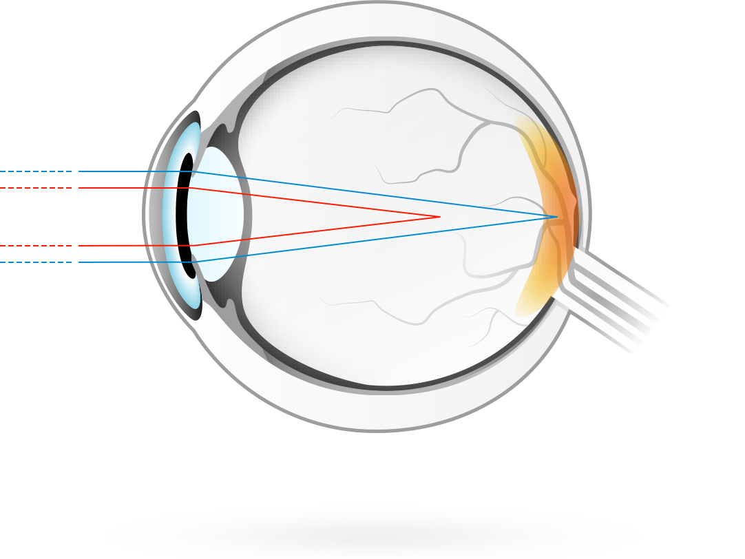 L'astigmatisme – condition dans laquelle la surface de la cornée présente une courbure asymétrique, de sorte que les rayons lumineux sont focalisés en deux points au lieu d'un seul, ce qui cause une vision floue