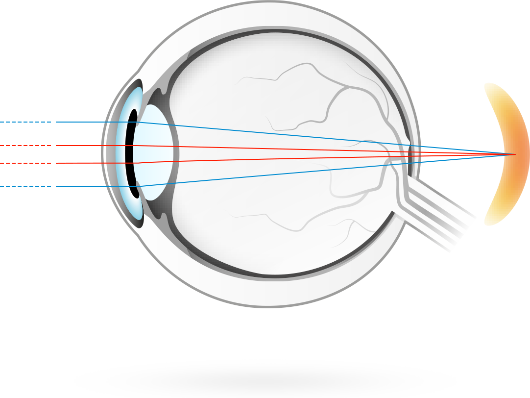 L'hypermétropie – condition dans laquelle la focalisation des images visuelles se fait en arrière de la rétine, ce qui rend la vue à de près plus floue, car l'œil a du mal à focaliser les objets proches