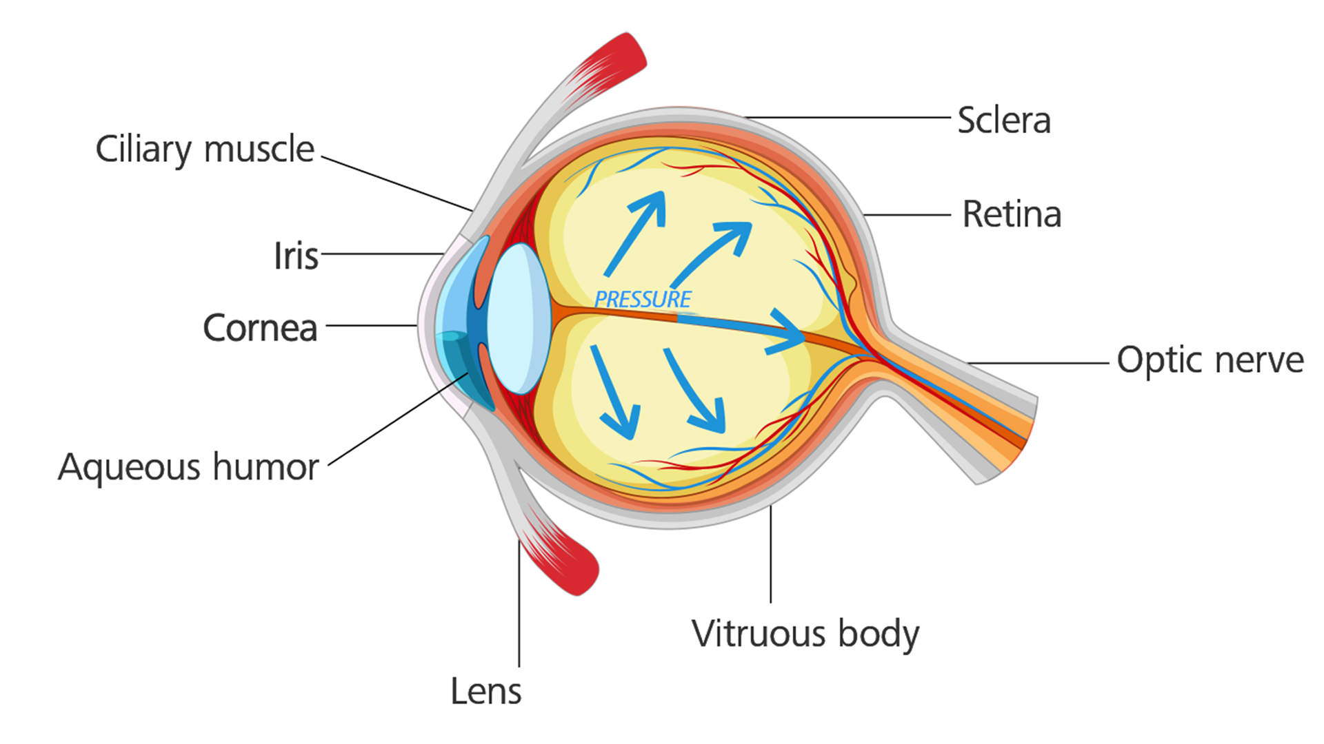 Œil atteint d&apos;un glaucome : la tension oculaire augmente et endommage le nerf optique.