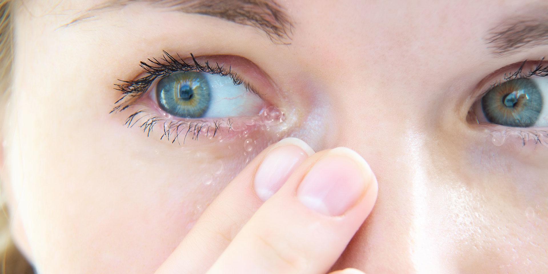 Gezondheidsprobleem: waterige ogen.