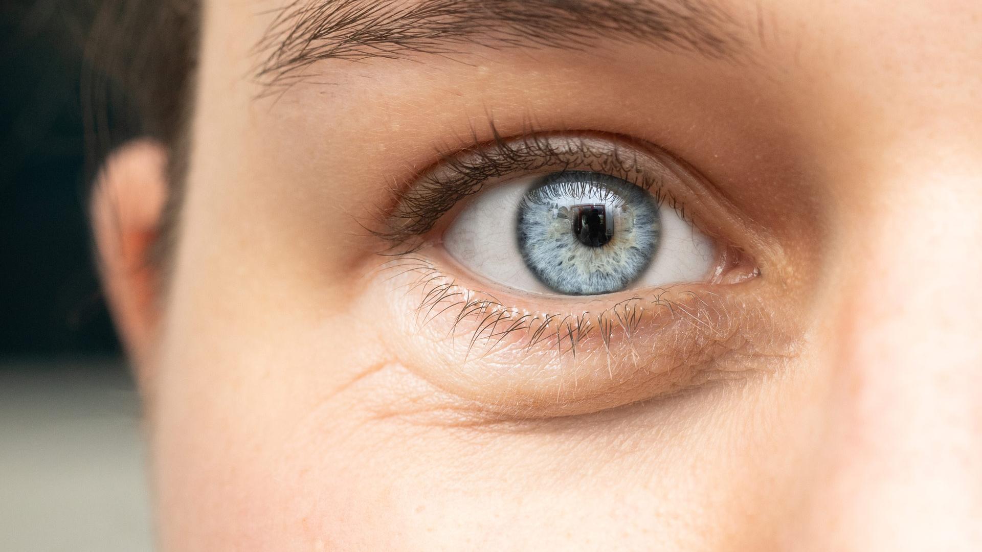 Yeux gonflés, cernés ; rougeurs et sensations de brûlures oculaires