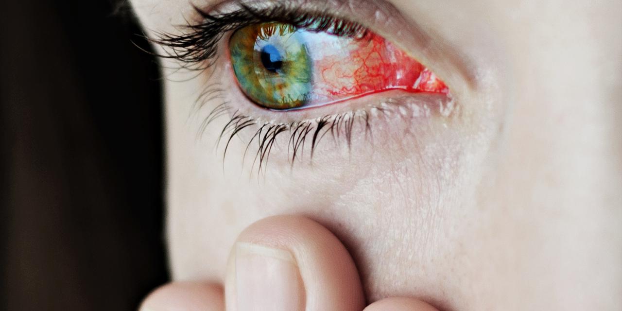 Plan rapproché d’yeux rougis, injectés de sang, soit irrités, soit infectés – uvéite.