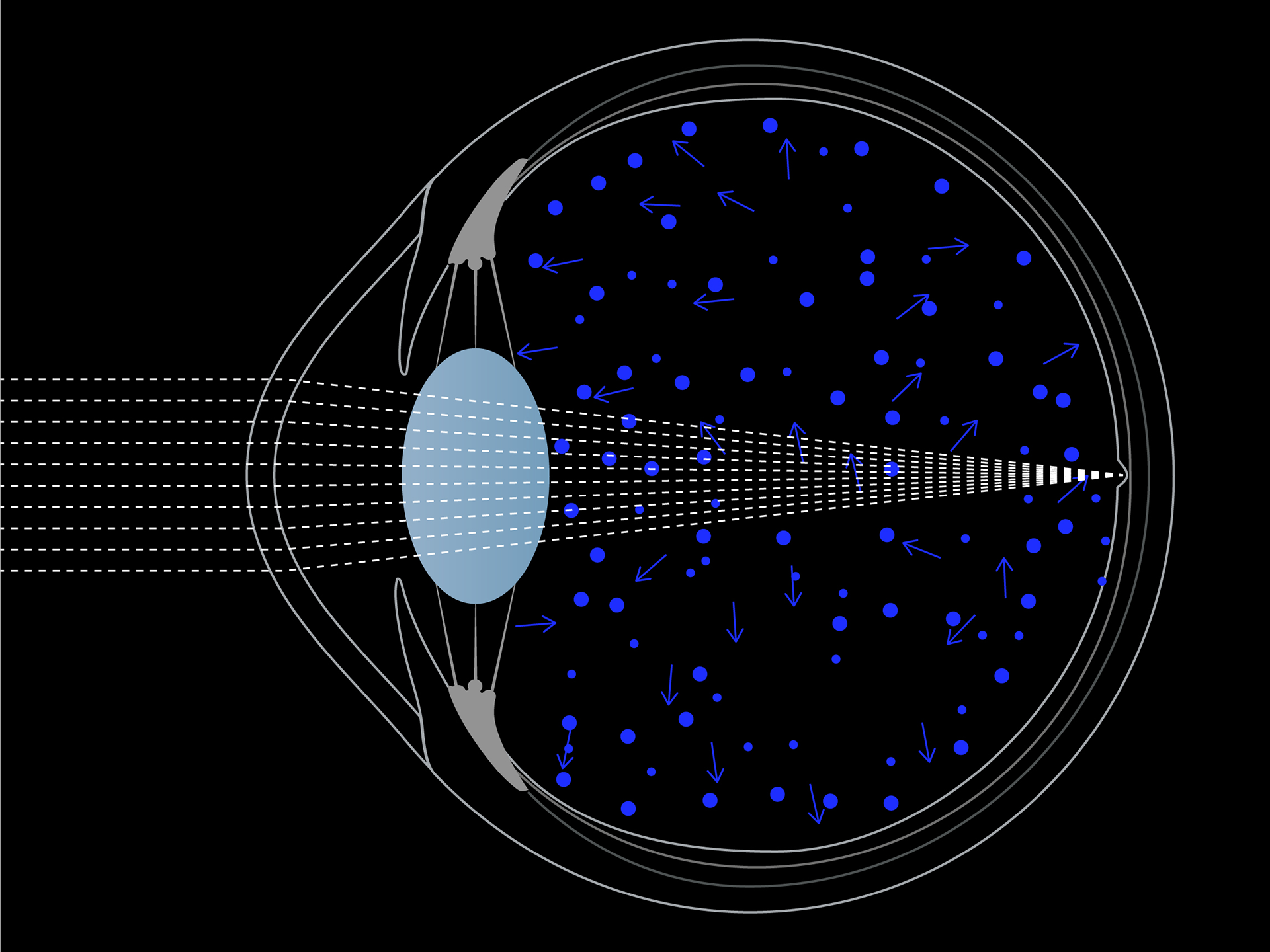 Visualisation schématique de la diffusion de la lumière bleue dans l'œil.
