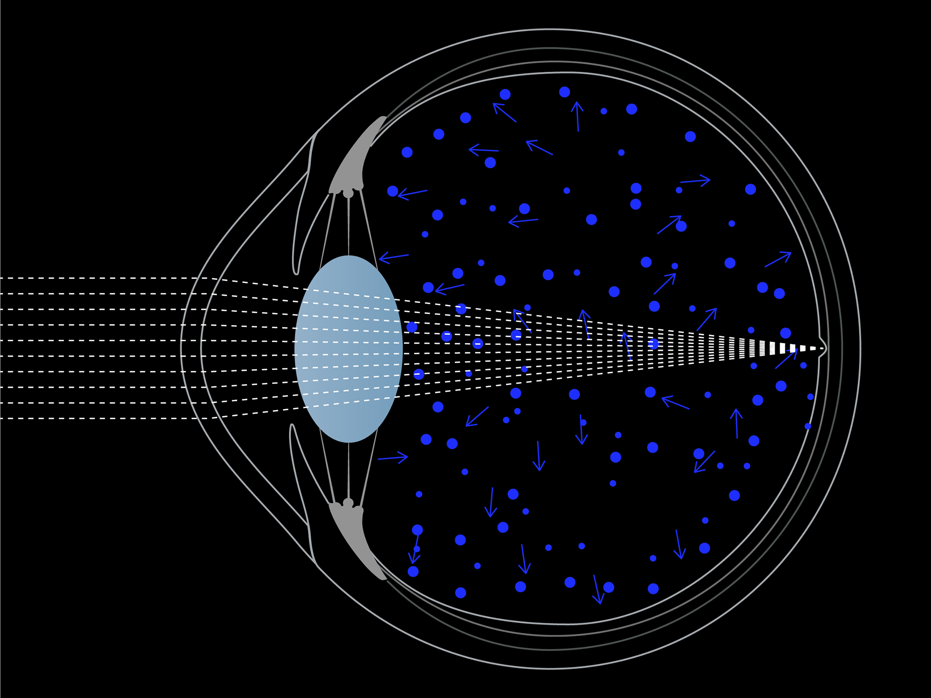 Schematische weergave van blauw licht verspreid in het oog.