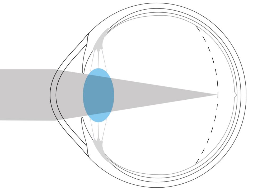 Illustration d'un œil myope qui montre que la lumière est focalisée devant la rétine.