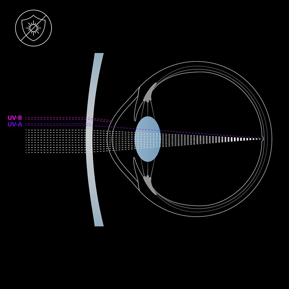 Illustratie van het oog en een lens zonder UV-bescherming, die UVA- en UVB-lichtstralen in het oog doorlaat.  