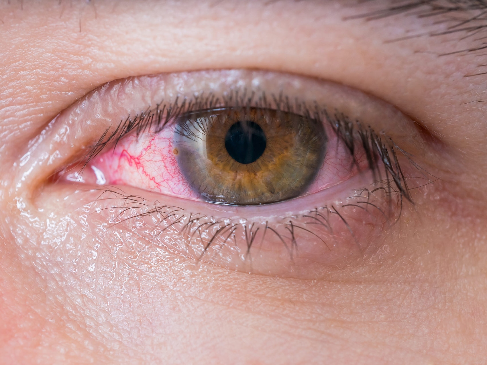De afbeelding toont een close-up van een ongezond oog, ter illustratie van hoe potentiële ooggevaren er uit kunnen zien. 
